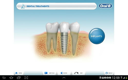 okc-oms: dental implants & oral surgery,Understanding Dental Implants